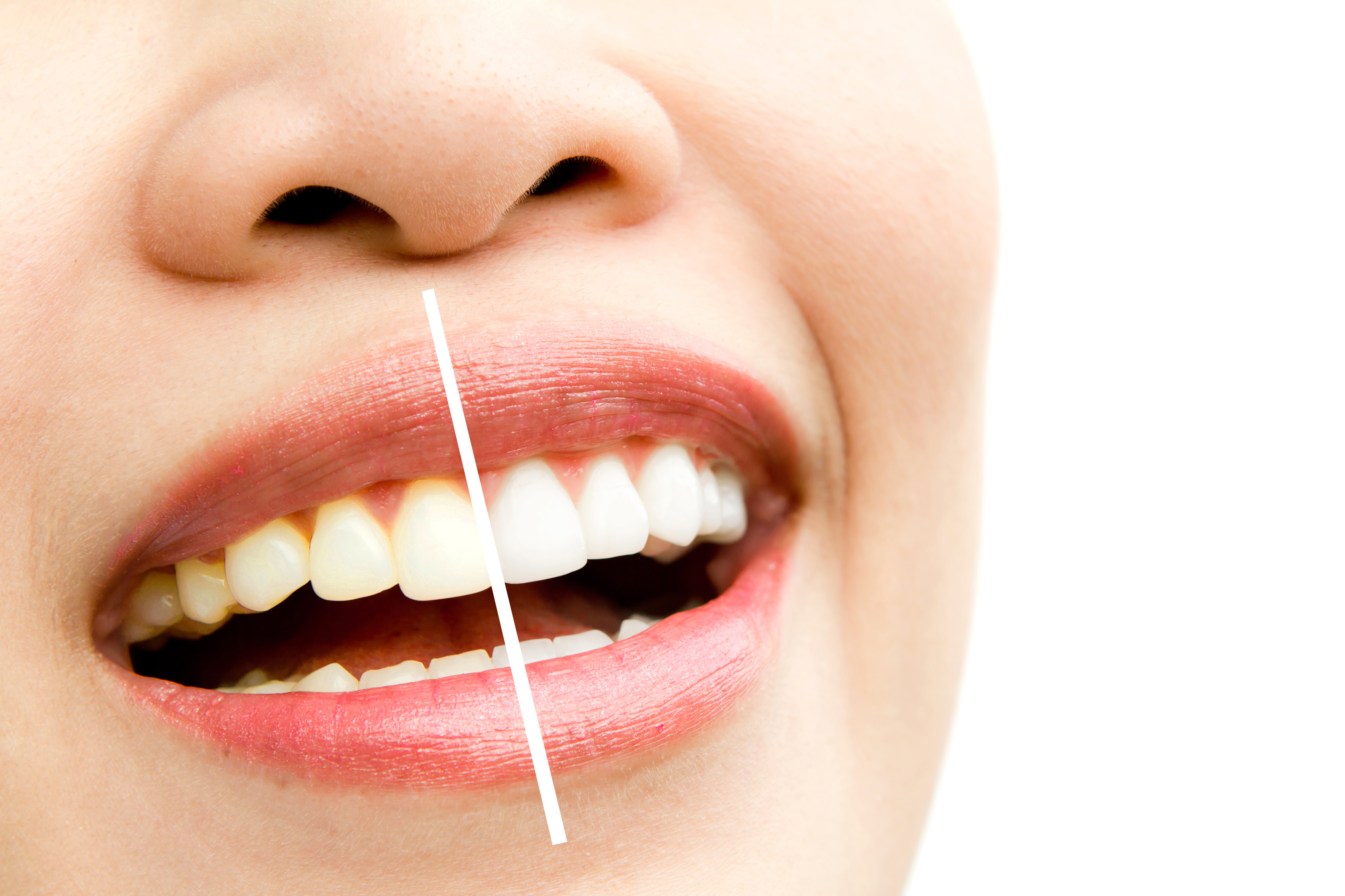 Root Canal Therapy